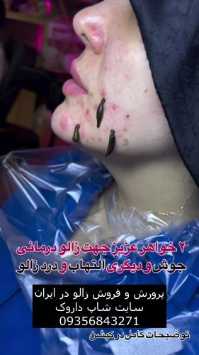 درمان جوش صورت و التهاب با زالو