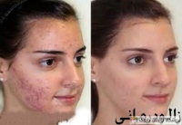 زالو آرایشی جوش و لک صورت