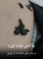 تنبلی تخمدان و نازایی