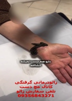 زالودرمانی گرفتگی کانال دست